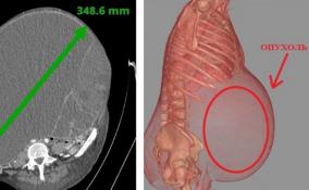 83-летней жительнице Ленобласти удалили опухоль весом 25 кг